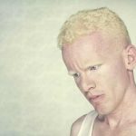 albinos 1