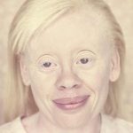 albinos 12