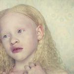 albinos 18